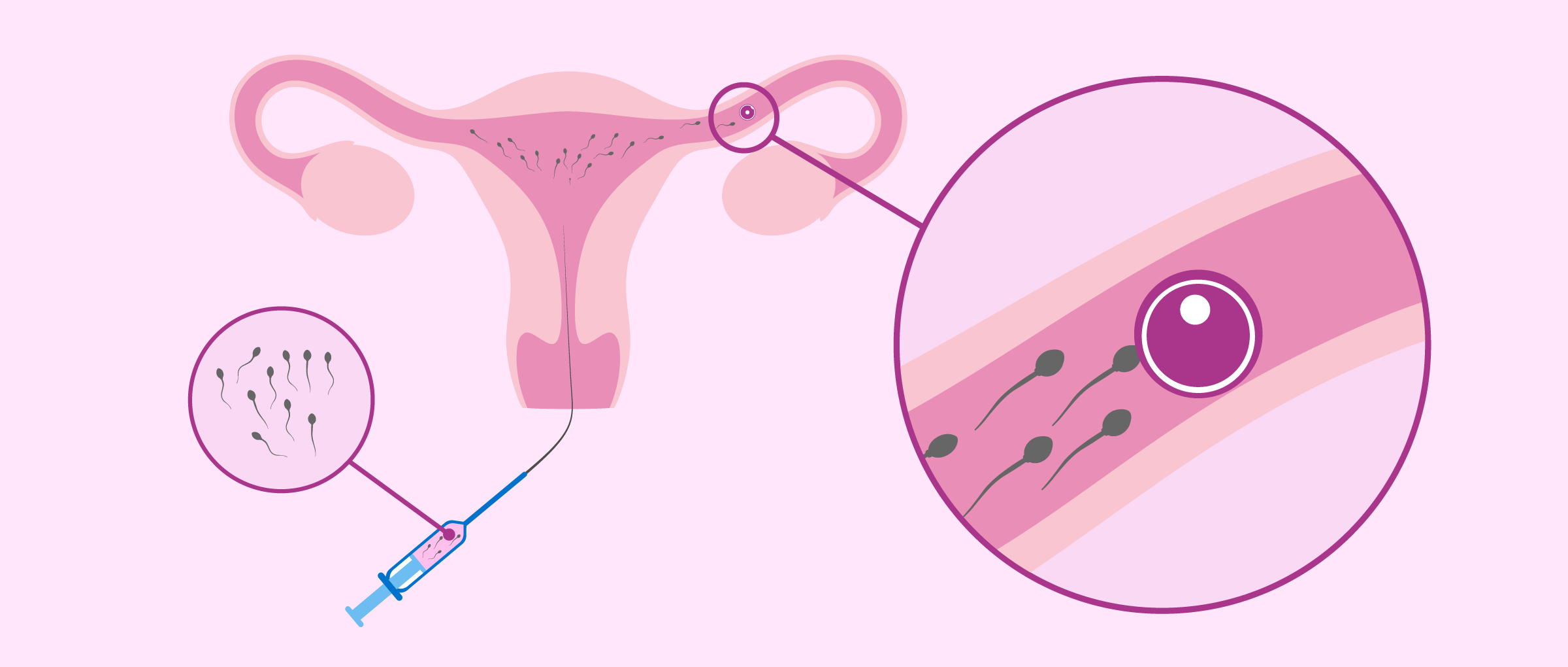 �Qu� es la inseminaci�n artificial y qu� tipos existen?